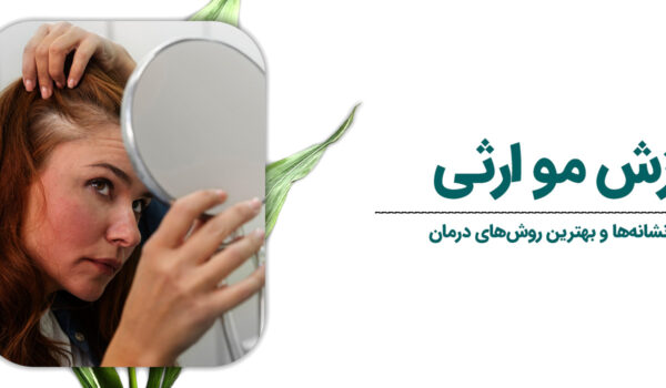 ریزش-مو-ارثی-1