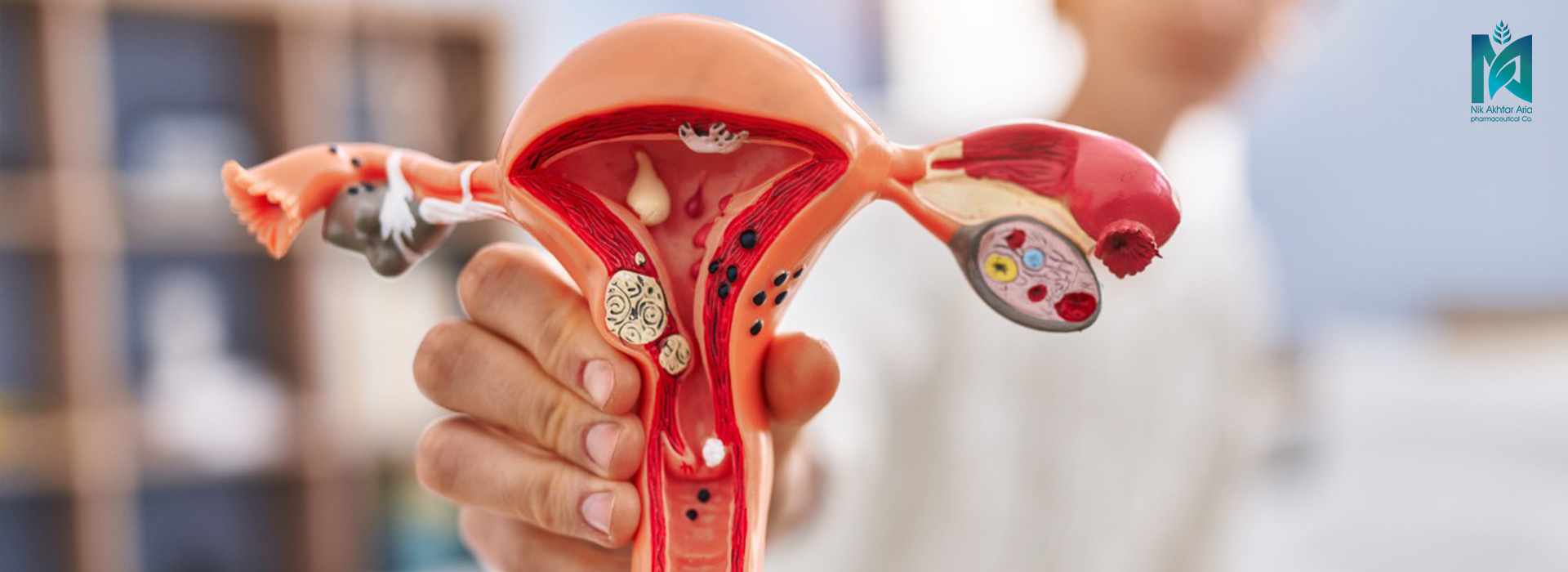 تخمدان پلی کیستیک PCOS1