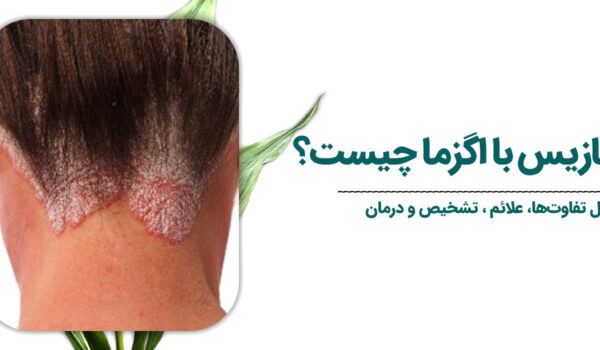 فرق-پسوریازیس-با-اگزما-چیست؟