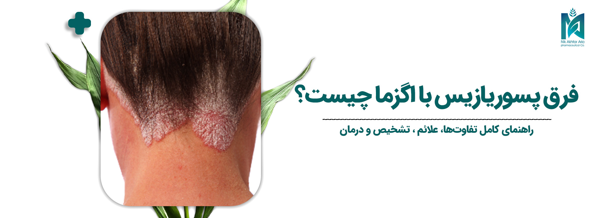 فرق-پسوریازیس-با-اگزما-چیست؟