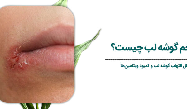 علت-زخم-گوشه-لب-چیست؟